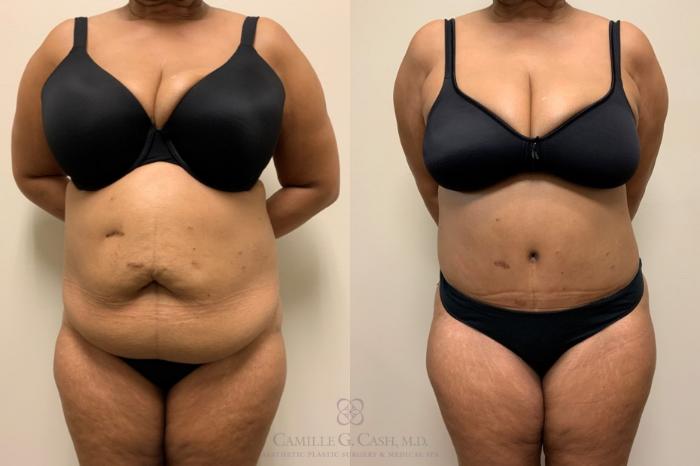Before & After Tummy Tuck Case 560 Front View in Houston, TX
