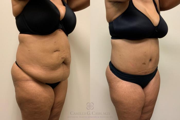 Before & After Tummy Tuck Case 560 Left Oblique View in Houston, TX