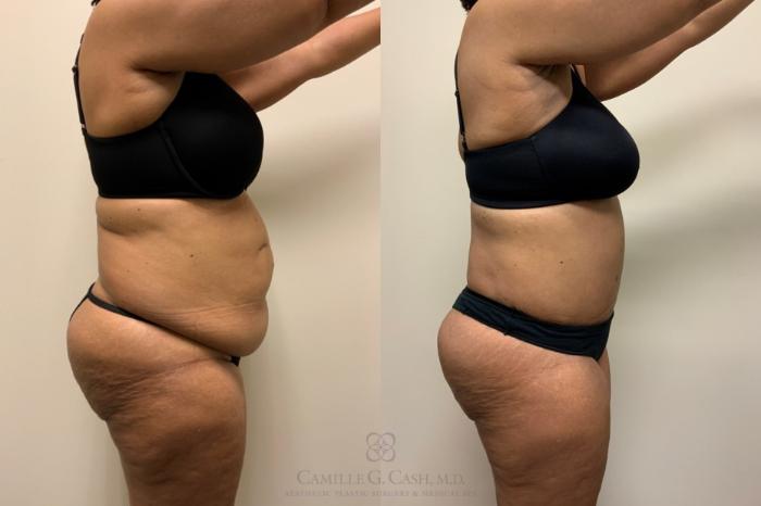 Before & After Tummy Tuck Case 560 Left Side View in Houston, TX
