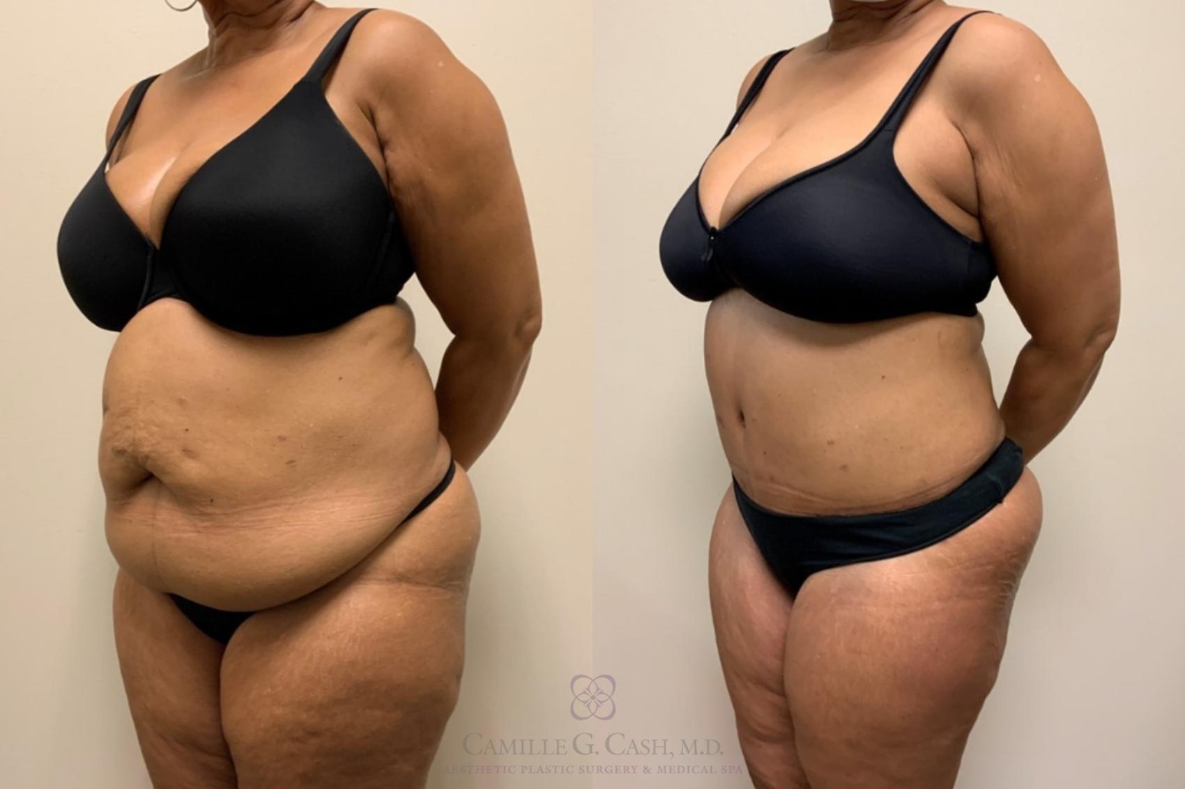 Before & After Tummy Tuck Case 560 Right Oblique View in Houston, TX