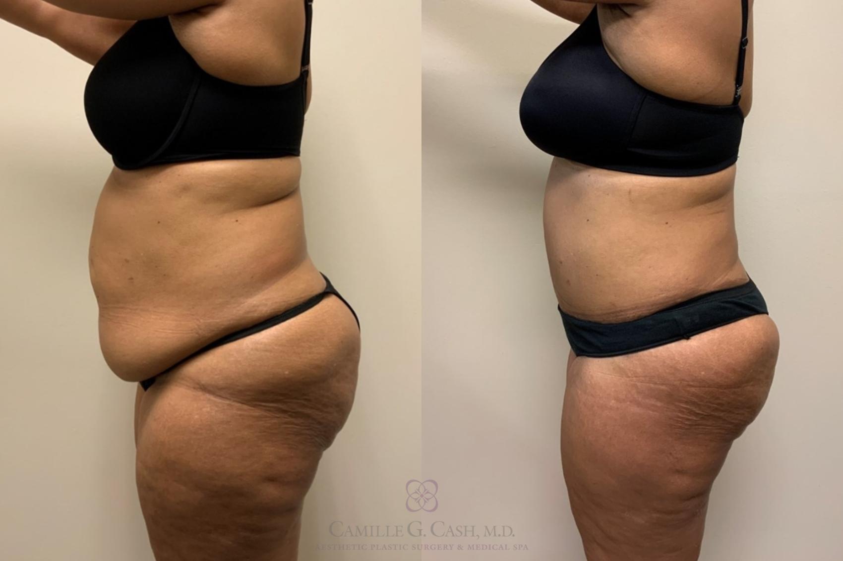 Before & After Tummy Tuck Case 560 Right Side View in Houston, TX