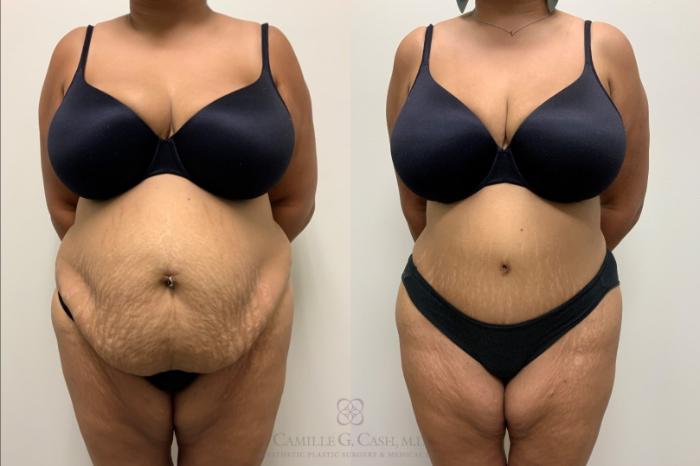 Before & After Tummy Tuck Case 562 Front View in Houston, TX