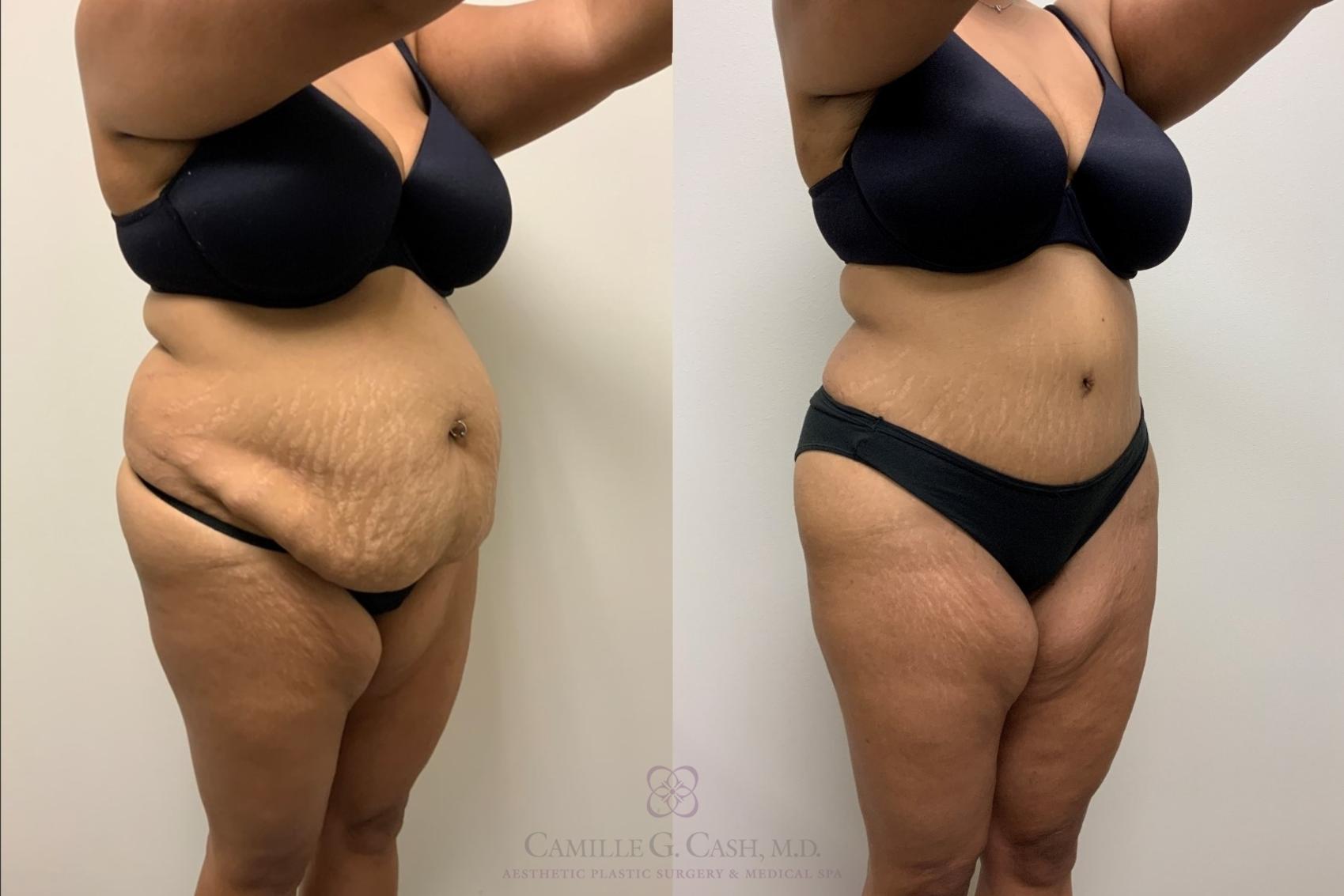 Before & After Tummy Tuck Case 562 Left Oblique View in Houston, TX