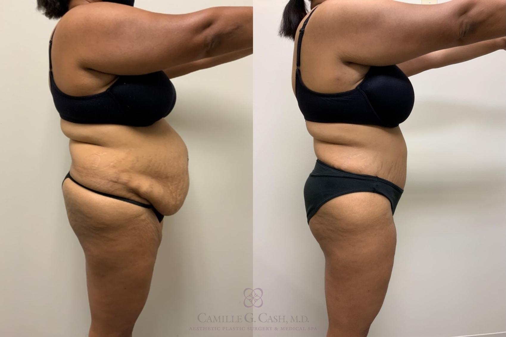 Before & After Tummy Tuck Case 562 Left Side View in Houston, TX