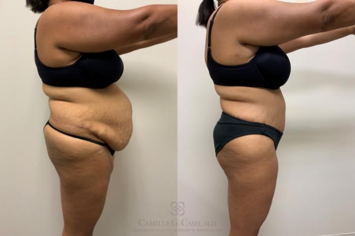 Before & After Tummy Tuck Case 562 Left Side View in Houston, TX