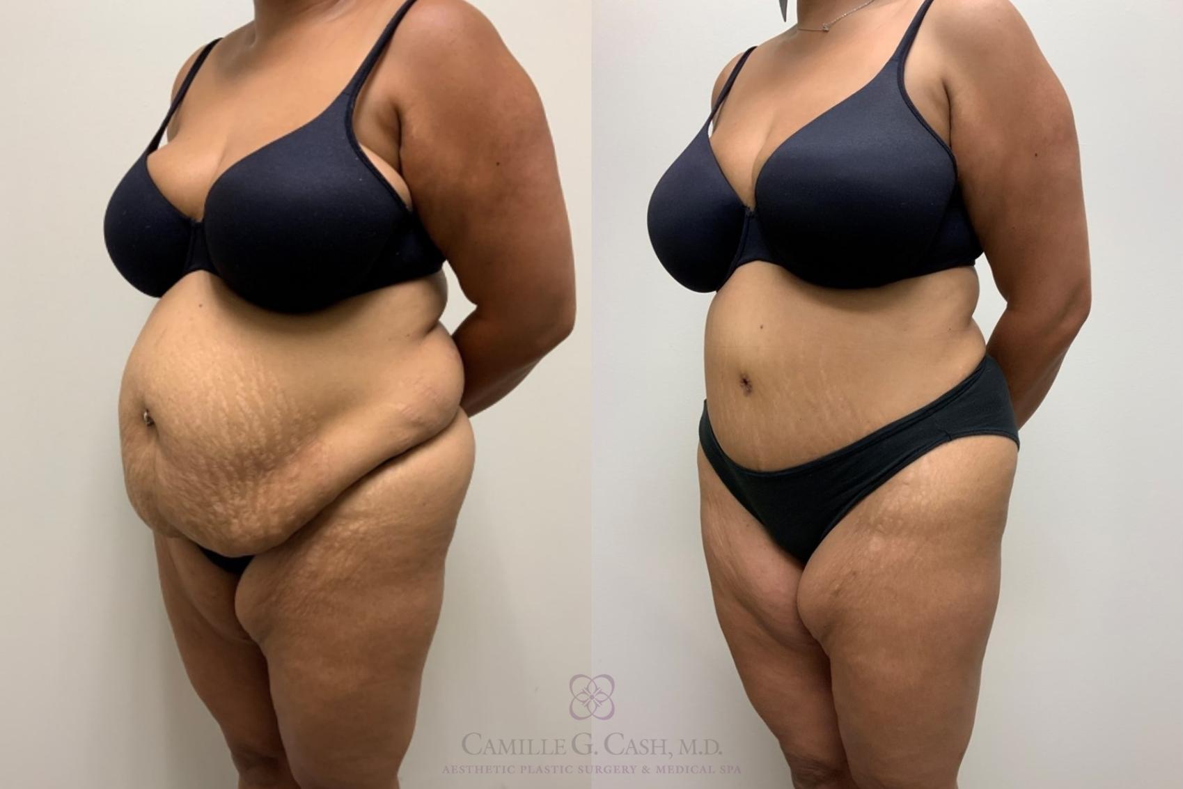 Before & After Tummy Tuck Case 562 Right Oblique View in Houston, TX