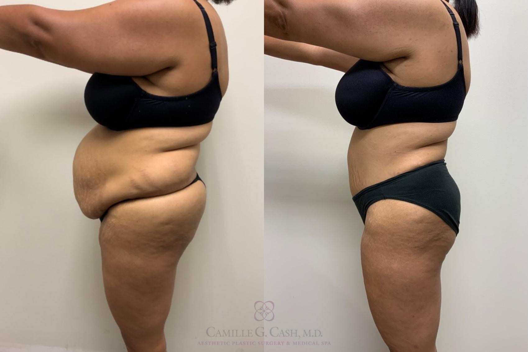 Before & After Tummy Tuck Case 562 Right Side View in Houston, TX