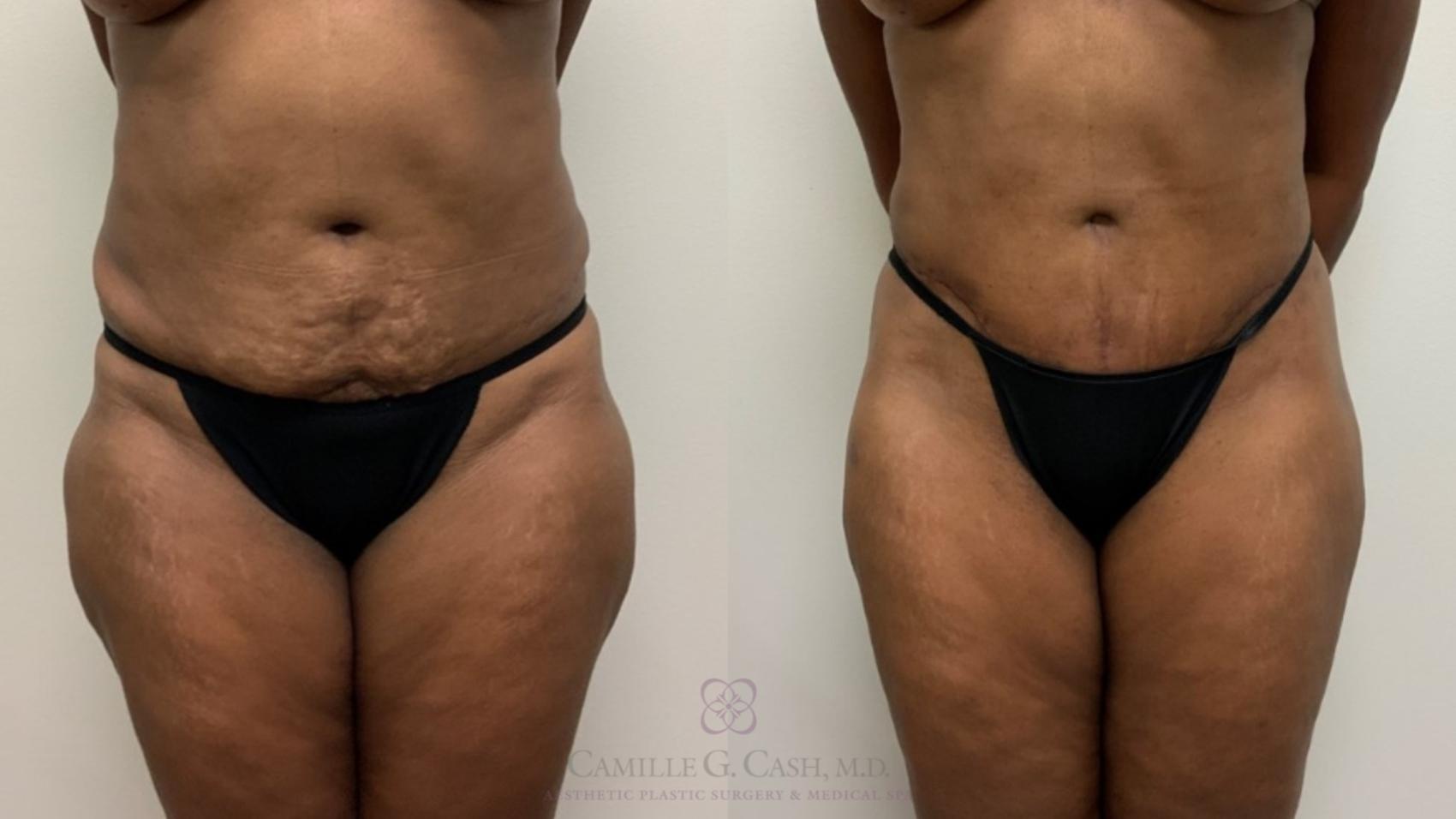 Before & After Tummy Tuck Case 563 Front View in Houston, TX