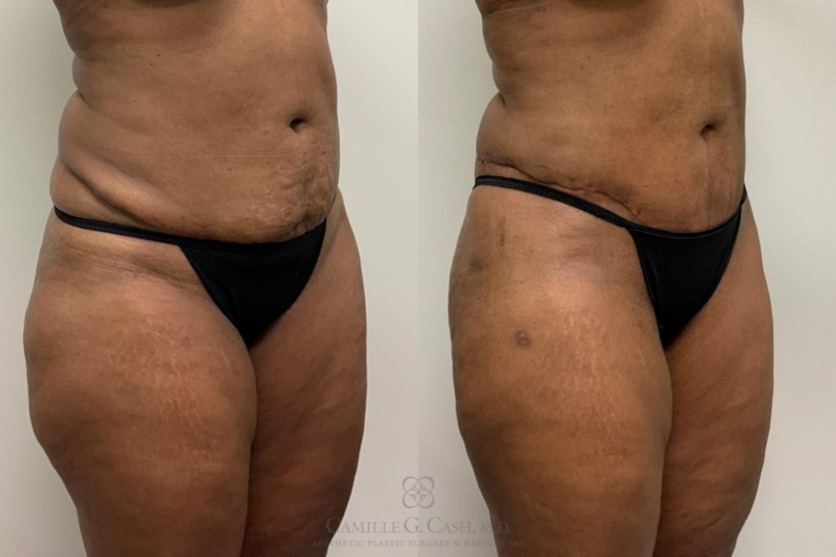 Before & After Tummy Tuck Case 563 Left Oblique View in Houston, TX