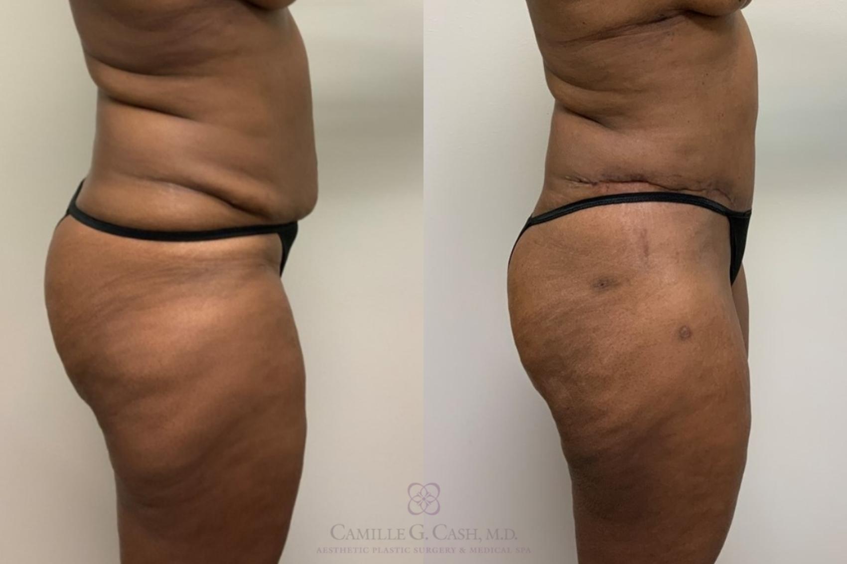 Before & After Tummy Tuck Case 563 Left Side View in Houston, TX