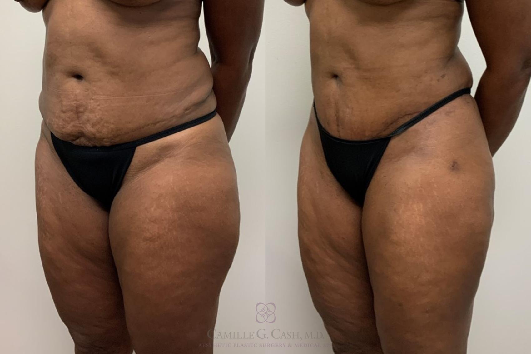 Before & After Tummy Tuck Case 563 Right Oblique View in Houston, TX