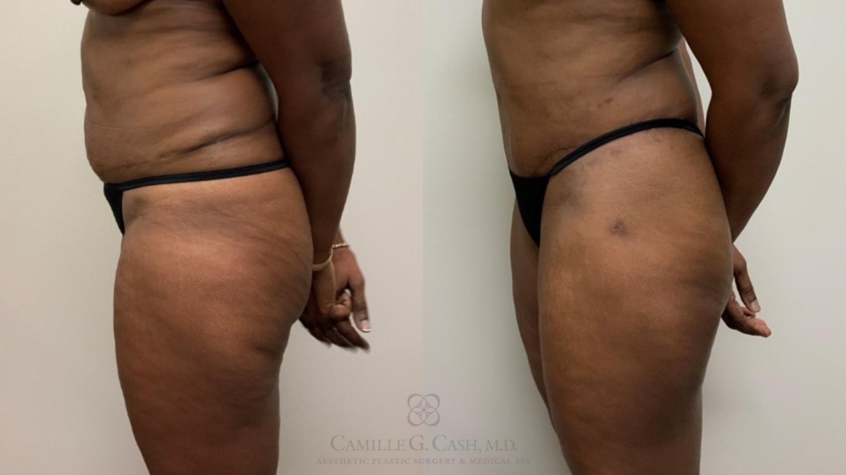 Before & After Tummy Tuck Case 563 Right Side View in Houston, TX