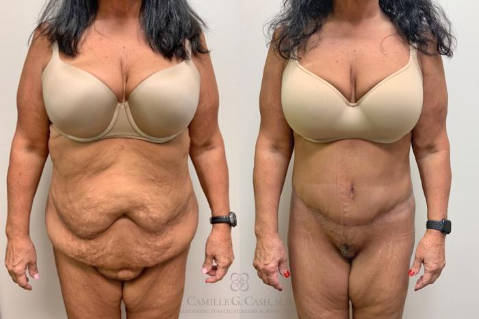 Before & After Tummy Tuck Case 570 Front View in Houston, TX
