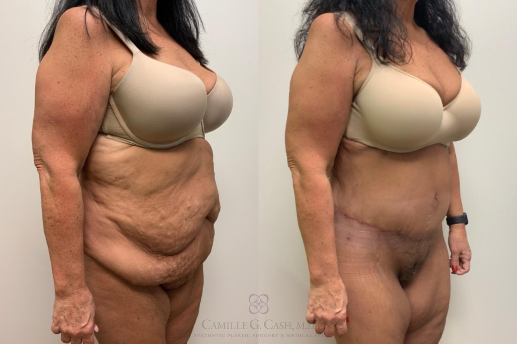 Before & After Tummy Tuck Case 570 Left Oblique View in Houston, TX