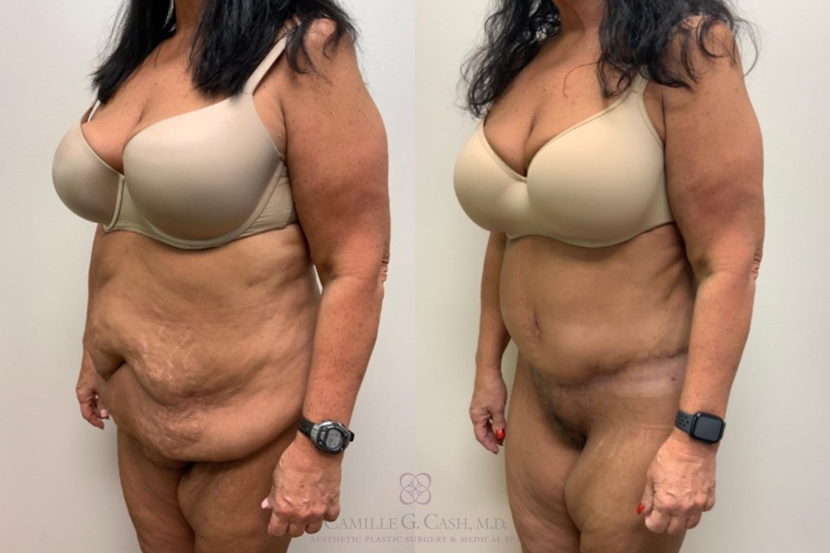 Before & After Post-Weight Loss Body Contouring Case 570 Right Oblique View in Houston, TX