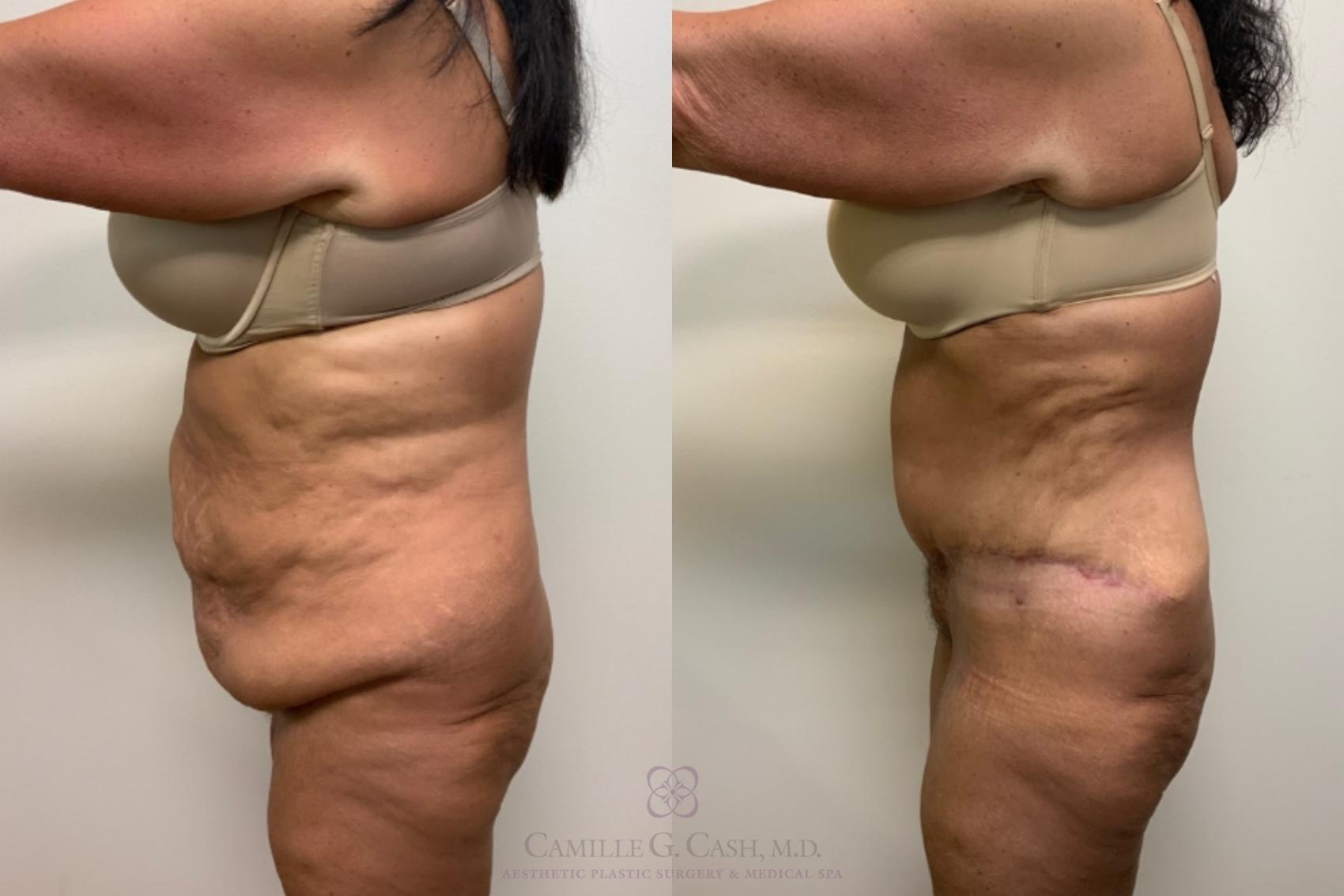 Before & After Tummy Tuck Case 570 Right Side View in Houston, TX