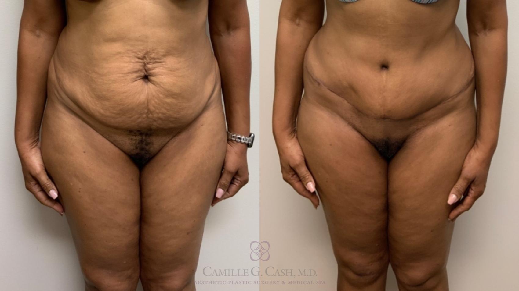 Before & After Tummy Tuck Case 573 Front View in Houston, TX