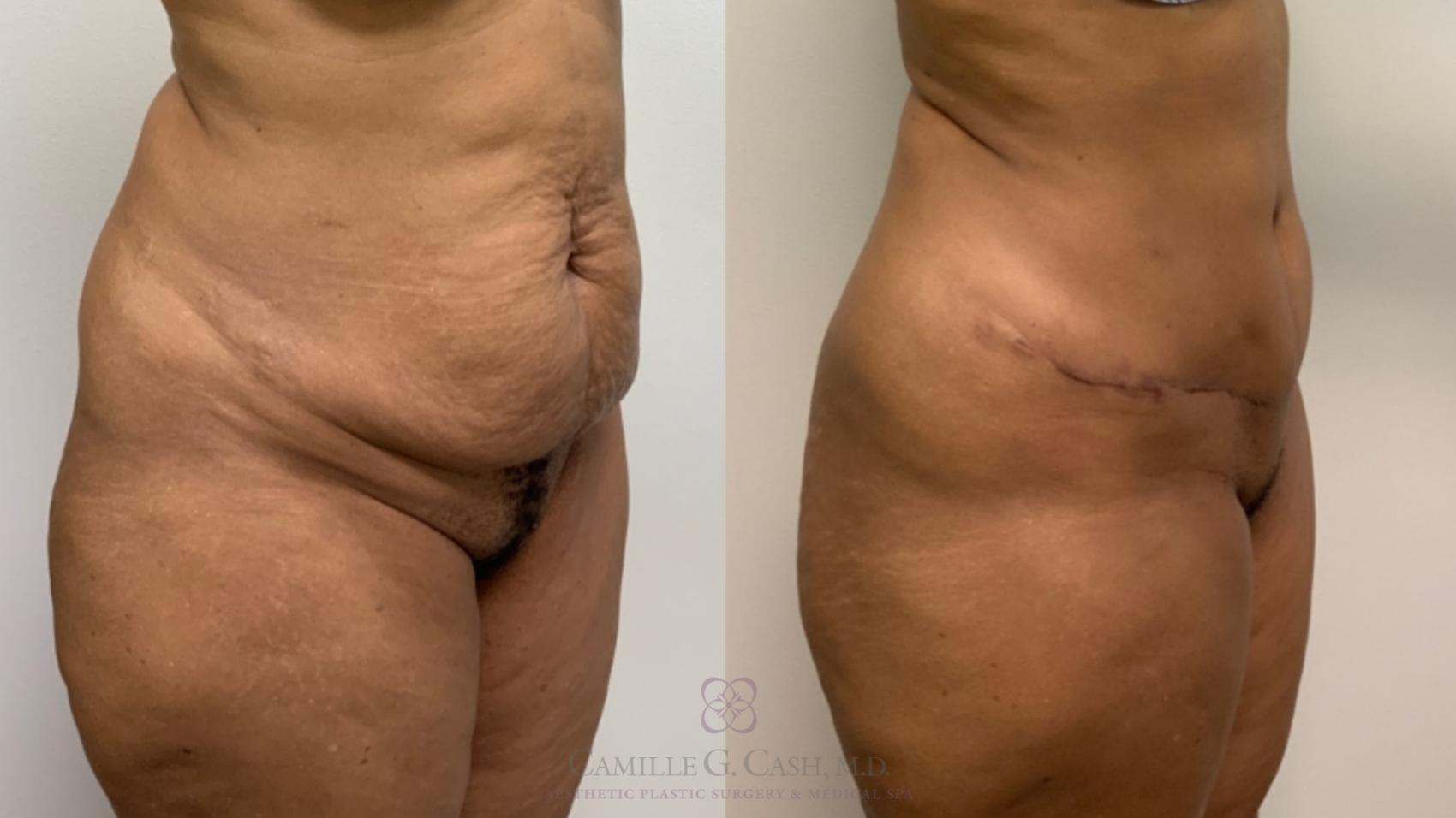 Before & After Tummy Tuck Case 573 Left Oblique View in Houston, TX