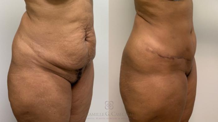 Before & After Tummy Tuck Case 573 Left Oblique View in Houston, TX