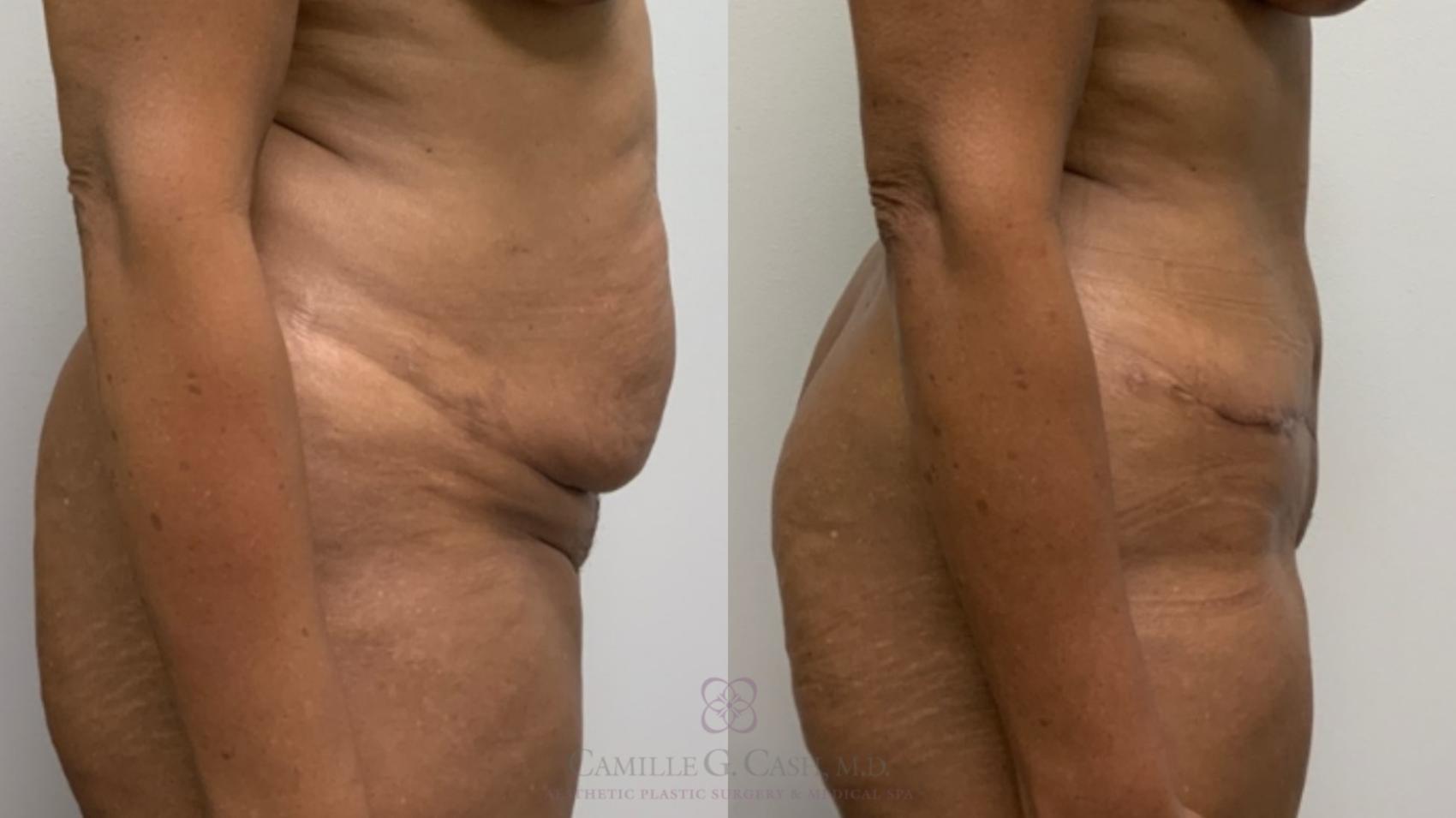 Before & After Tummy Tuck Case 573 Left Side View in Houston, TX