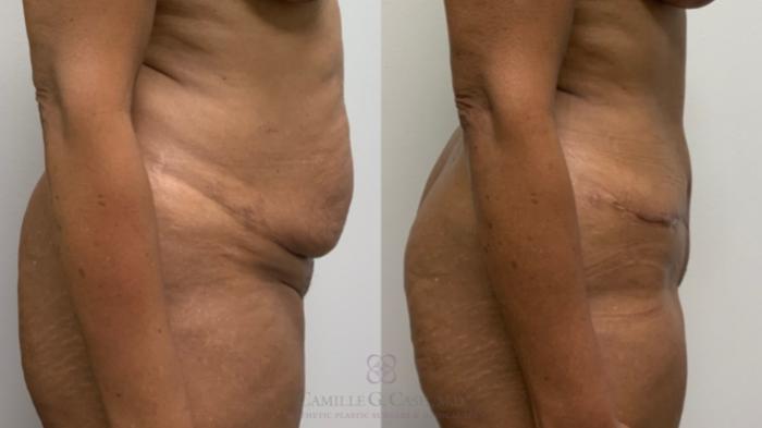 Before & After Tummy Tuck Case 573 Left Side View in Houston, TX
