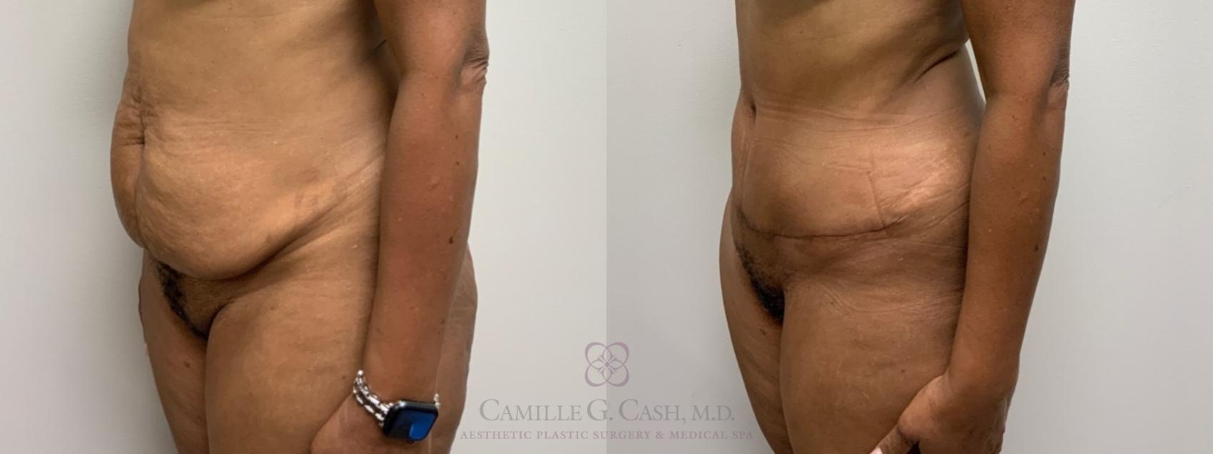 Before & After Tummy Tuck Case 573 Right Oblique View in Houston, TX