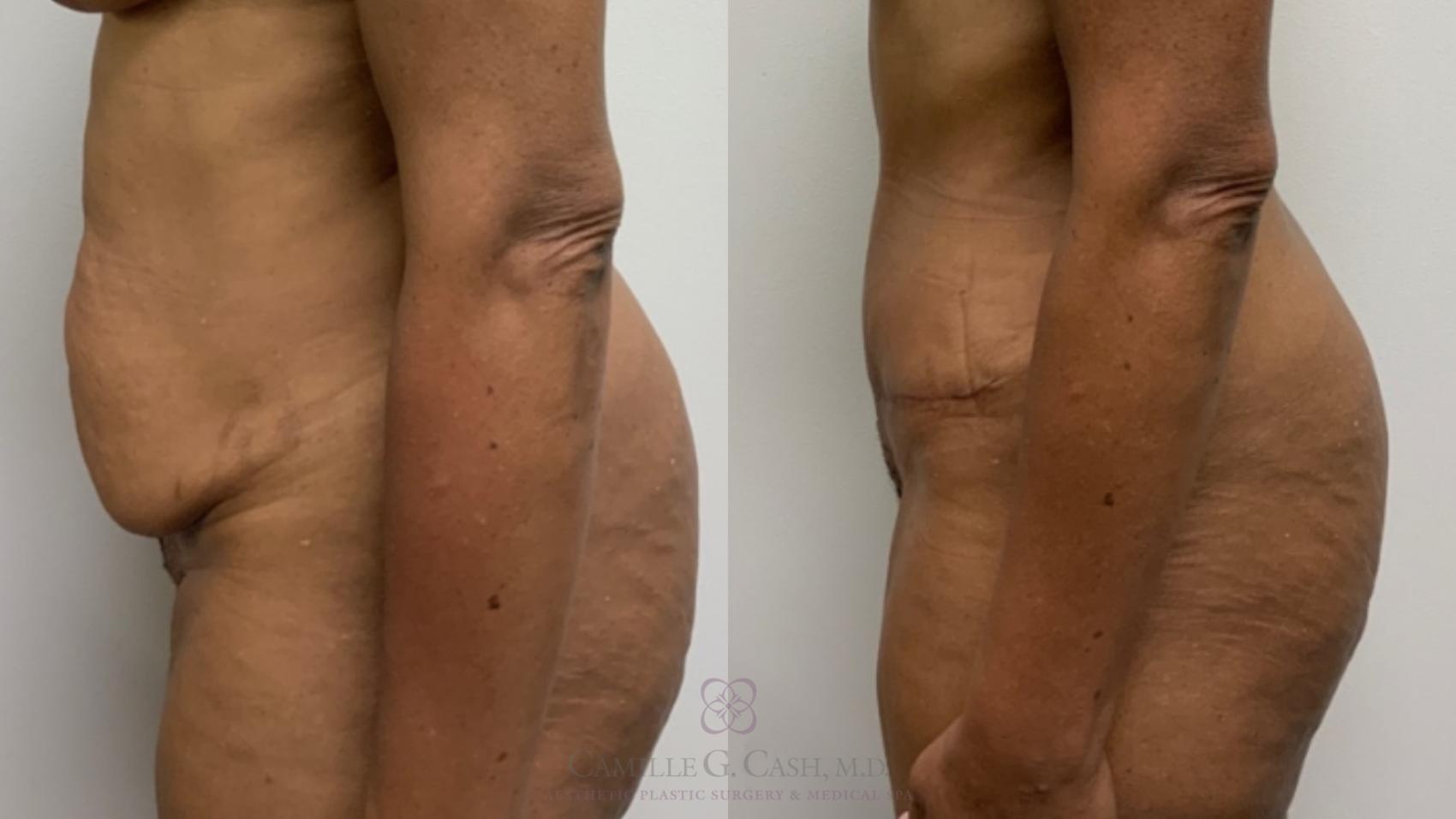 Before & After Tummy Tuck Case 573 Right Side View in Houston, TX