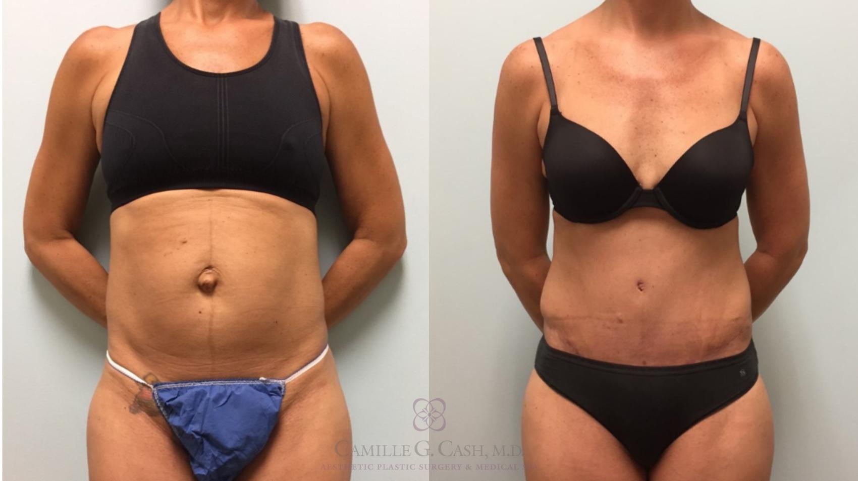 Before & After Tummy Tuck Case 577 Front View in Houston, TX