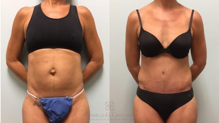 Before & After Tummy Tuck With Hernia Repair Case 577 Front View in Houston, TX