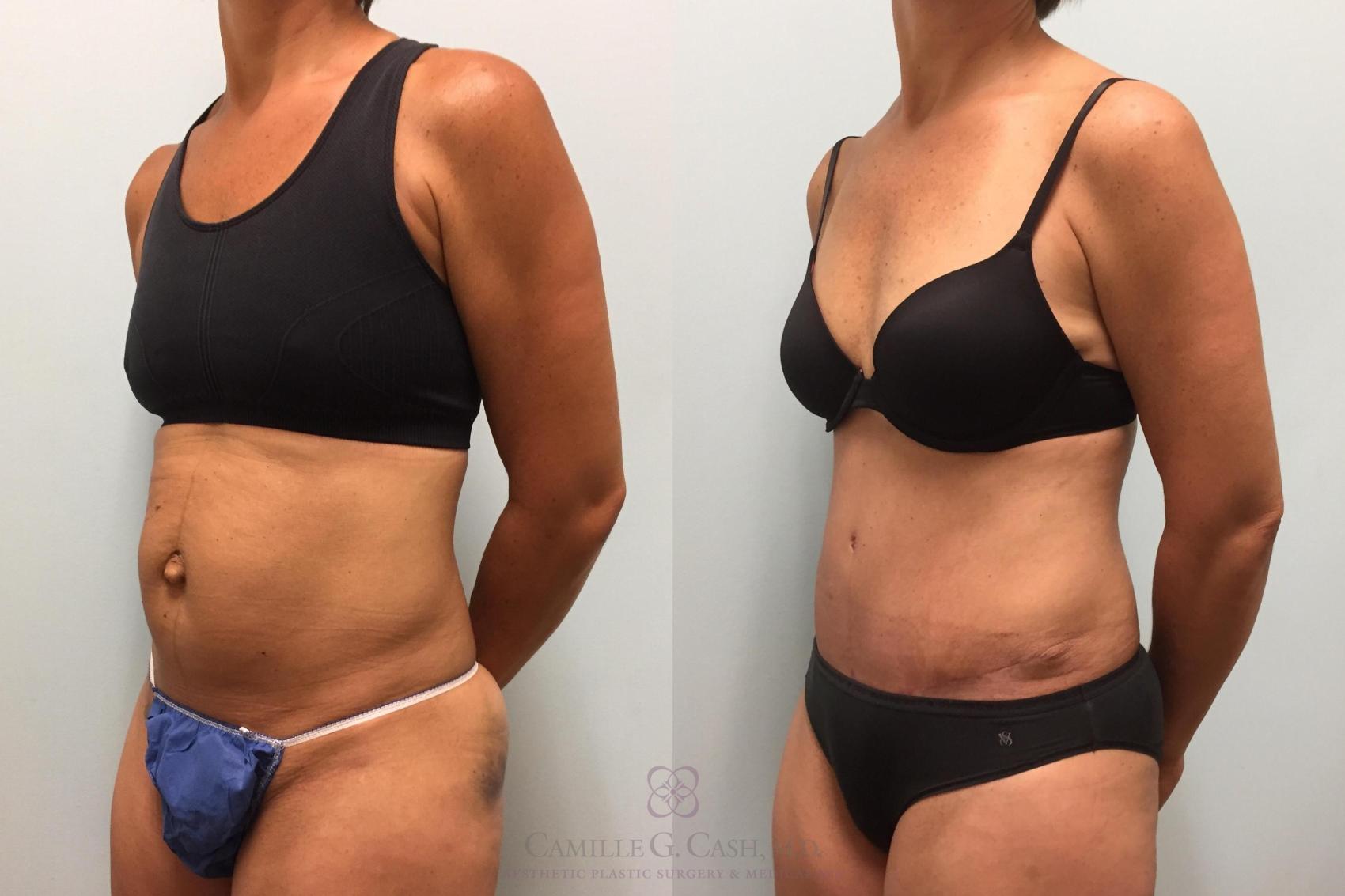 Before & After Tummy Tuck Case 577 Left Oblique View in Houston, TX