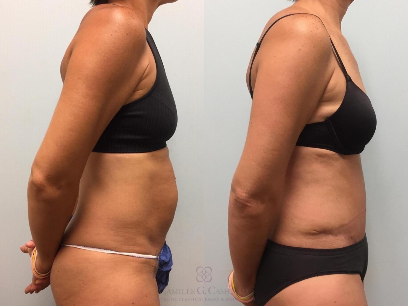 Before & After Tummy Tuck Case 577 Left Side View in Houston, TX