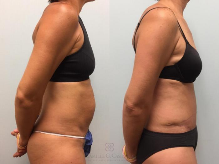 Before & After Tummy Tuck With Hernia Repair Case 577 Left Side View in Houston, TX