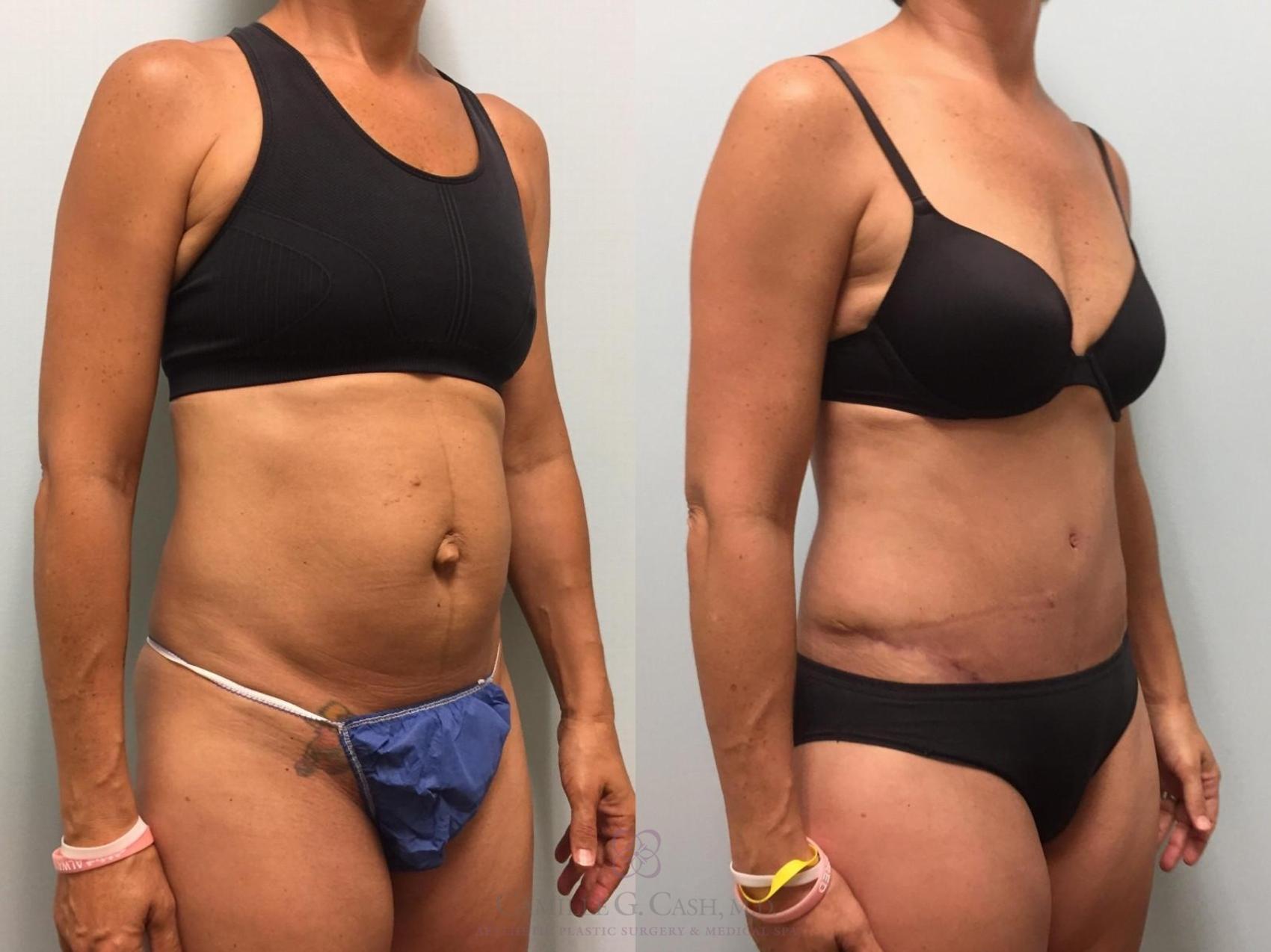 Before & After Tummy Tuck Case 577 Right Oblique View in Houston, TX