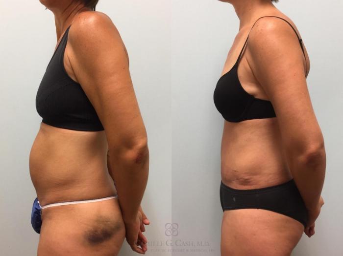 Before & After Tummy Tuck With Hernia Repair Case 577 Right Side View in Houston, TX