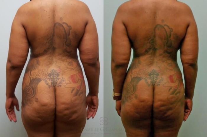 Before & After Tummy Tuck Case 580 Back View in Houston, TX