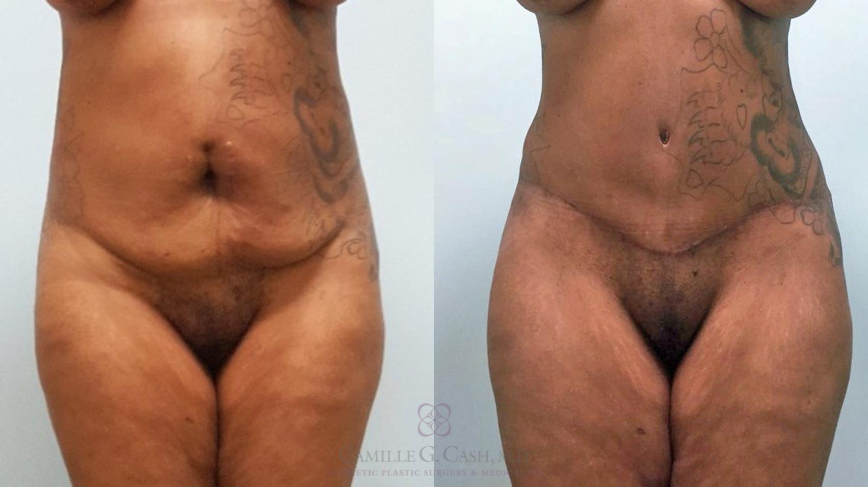 Before & After Tummy Tuck Case 580 Front View in Houston, TX