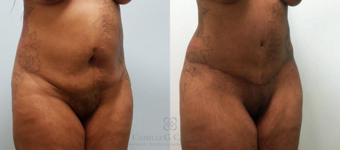 Before & After Tummy Tuck Case 580 Left Oblique View in Houston, TX