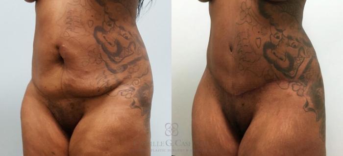 Before & After Tummy Tuck Case 580 Right Oblique View in Houston, TX
