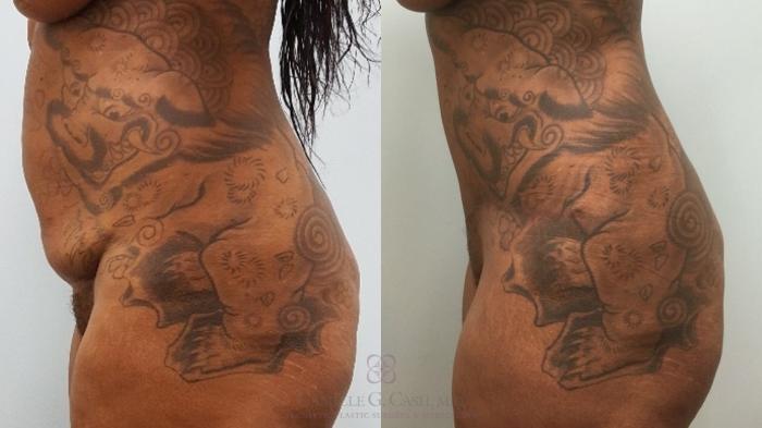 Before & After Tummy Tuck Case 580 Right Side View in Houston, TX
