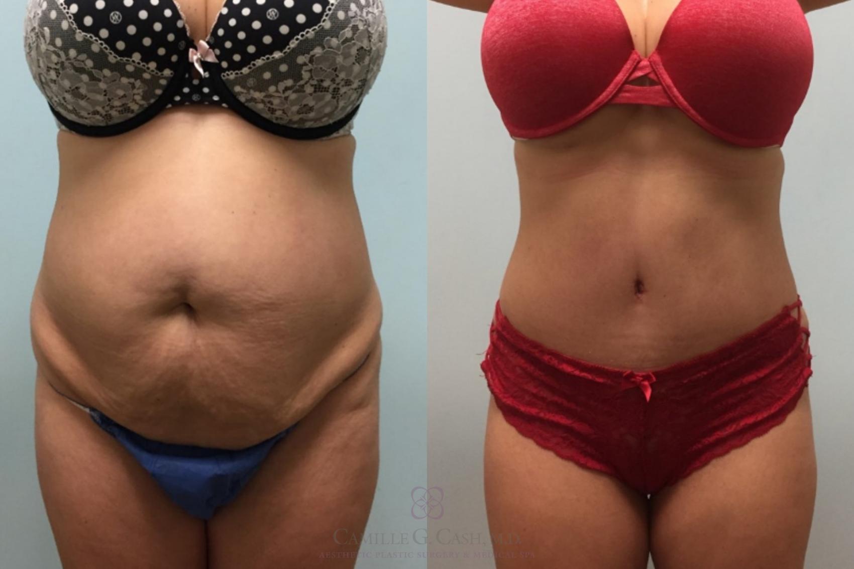 Before & After Tummy Tuck Case 602 Front View in Houston, TX