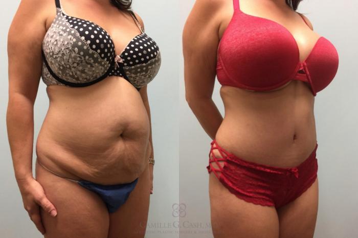 Before & After Tummy Tuck Case 602 Left Oblique View in Houston, TX