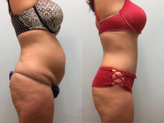 Before & After Tummy Tuck Case 602 Left Side View in Houston, TX