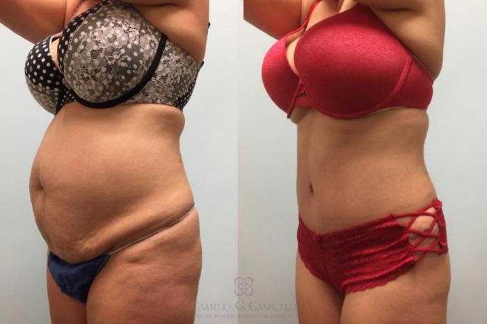 Before & After Tummy Tuck Case 602 Right Oblique View in Houston, TX
