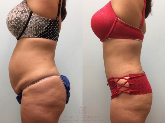 Before & After Tummy Tuck Case 602 Right Side View in Houston, TX