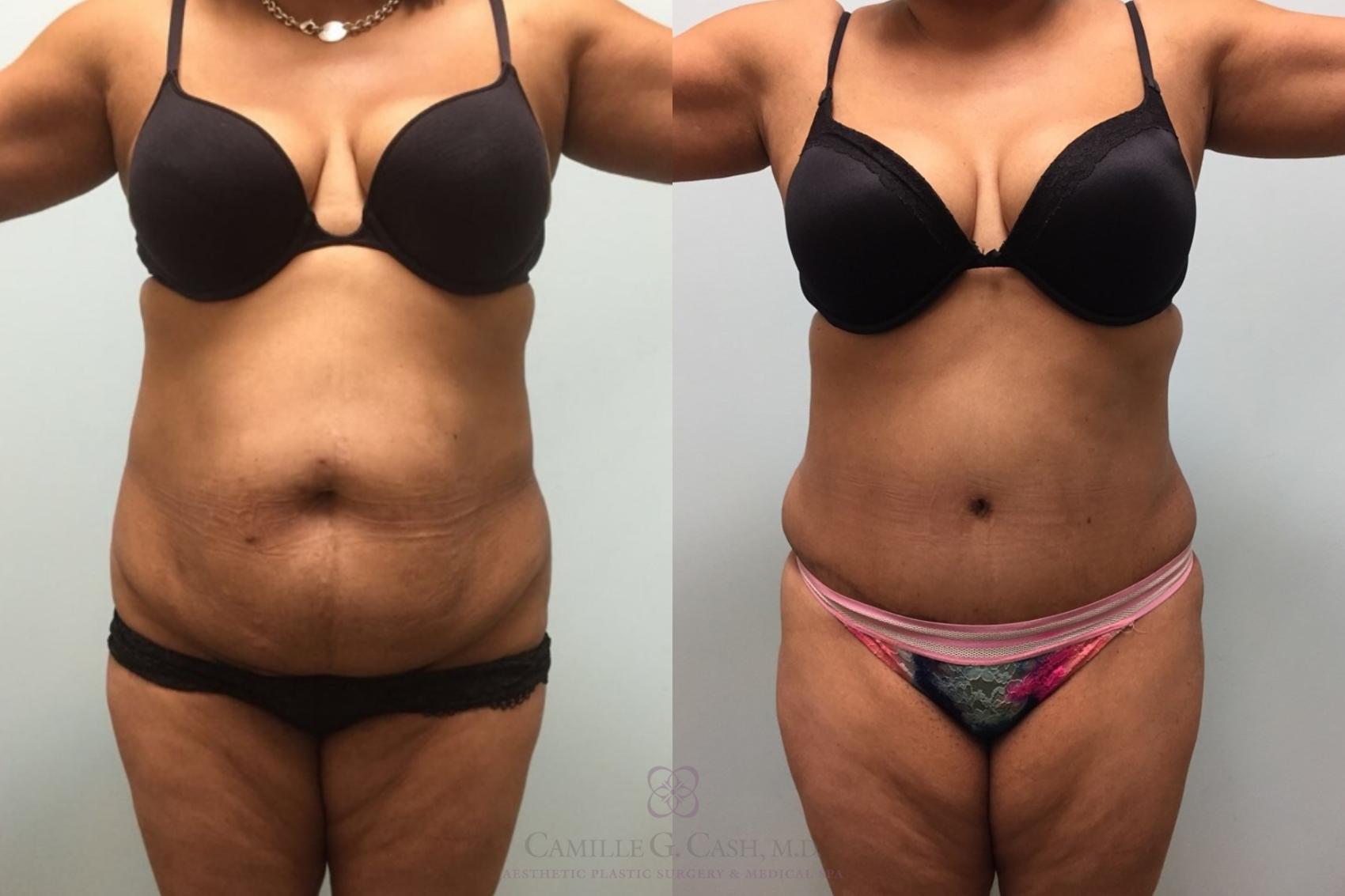Before & After Tummy Tuck Case 603 Front View in Houston, TX