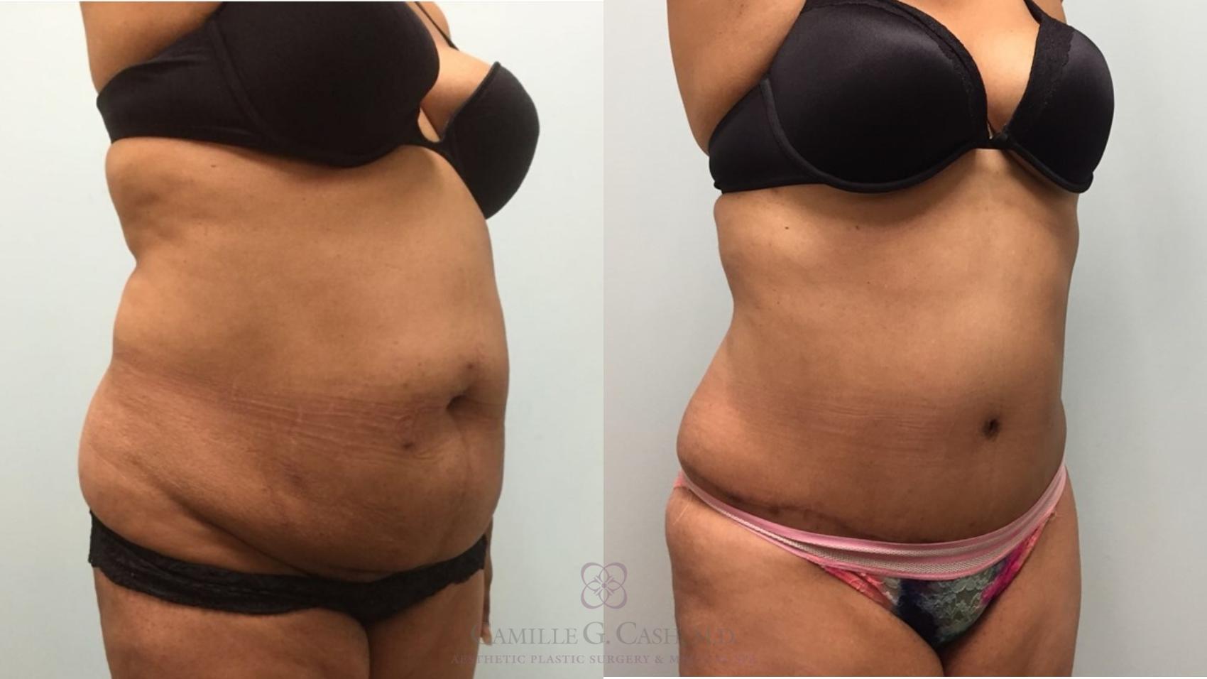 Before & After Tummy Tuck Case 603 Left Oblique View in Houston, TX