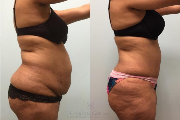Before & After Tummy Tuck Case 603 Left Side View in Houston, TX