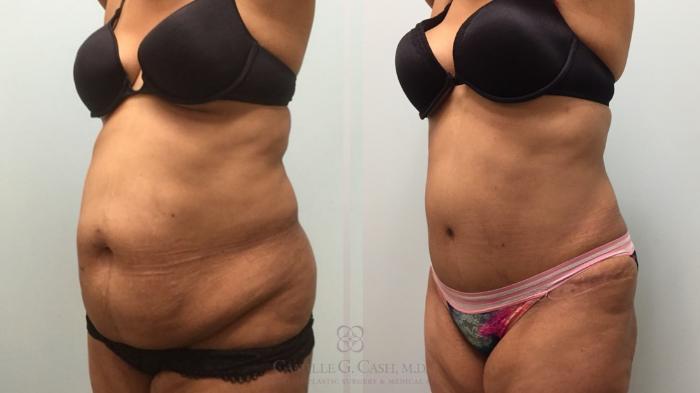 Before & After Tummy Tuck Case 603 Right Oblique View in Houston, TX