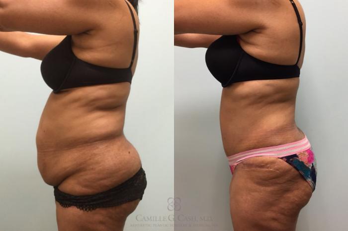 Before & After Tummy Tuck Case 603 Right Side View in Houston, TX