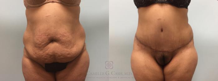 Before & After Tummy Tuck Case 616 Front View in Houston, TX